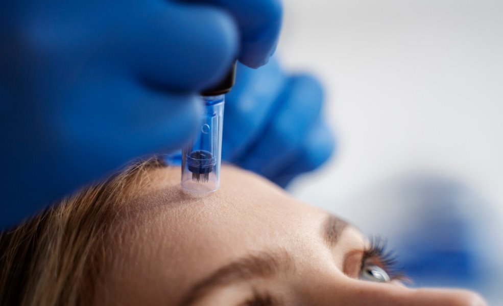 Microneedling